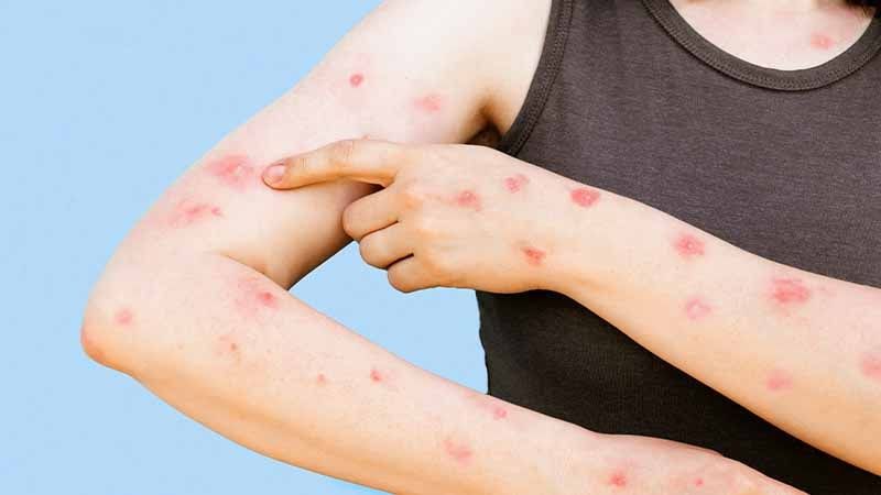 Monkeypox Understanding Symptoms and Prevention